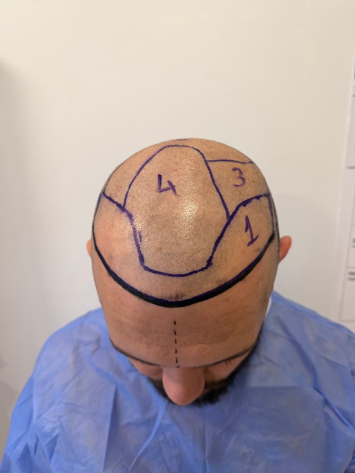 Techestetik Saç Ekim Merkezi - Hair Transplant Istanbul