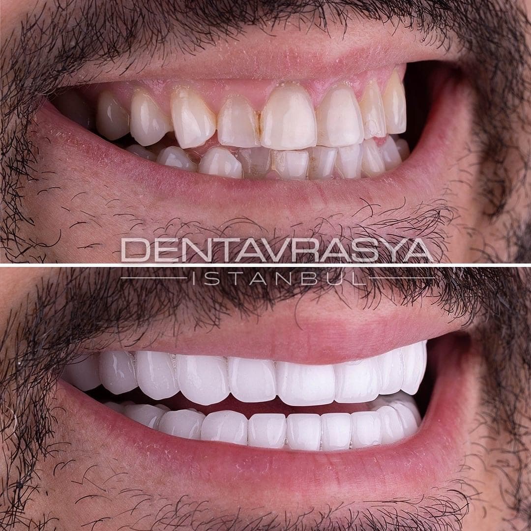 Dentavrasya Ağız ve Diş Sağlığı Polikliniği | Dentist Turkey | Dental Veneers İstanbul | Veneers in Turkey | Veneers in Istanbul | Dentist in Istanbul | EMAX Veneers Turkey | Zirconium Veneers Turkey | Dental Clinic Turkey Istanbul | implant Turkey