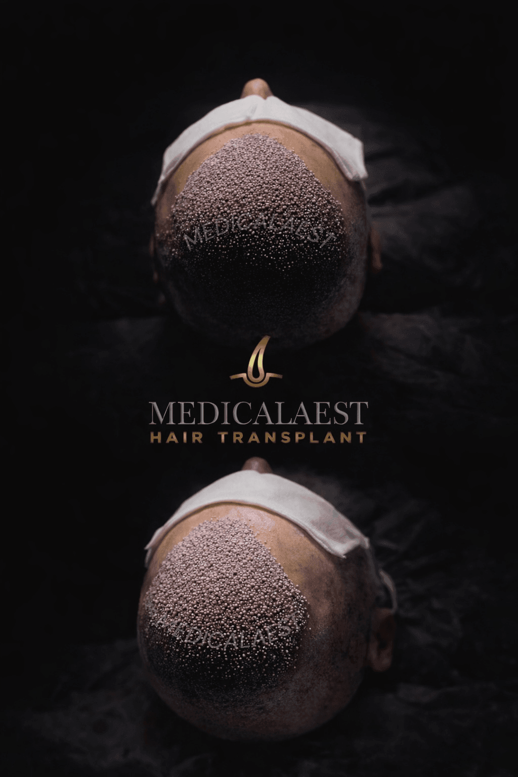 Medicalaest Hair Transplant Turkey Greffe de Cheveux Turquie