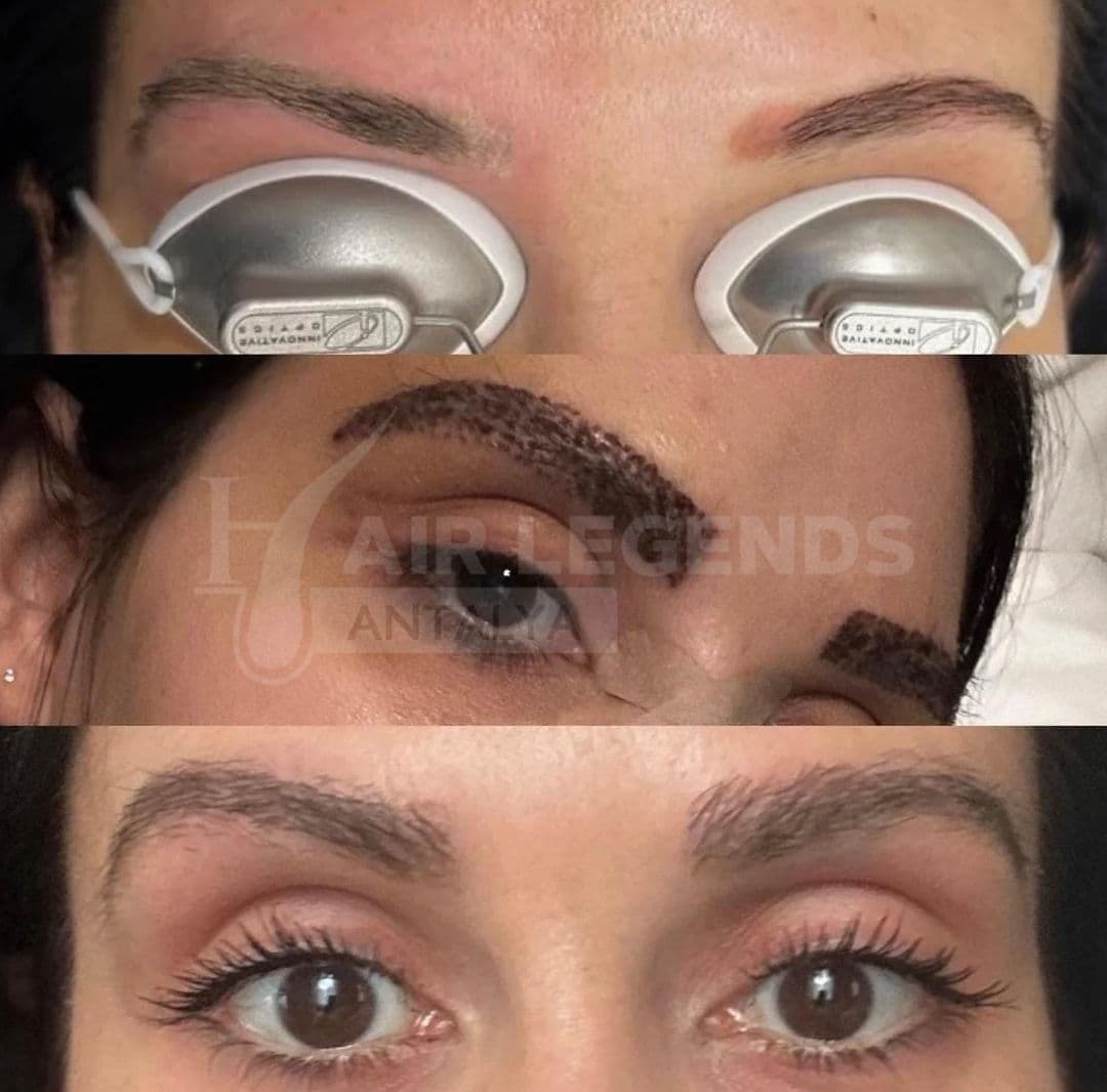 Hair Legends | Hair Transplant Antalya