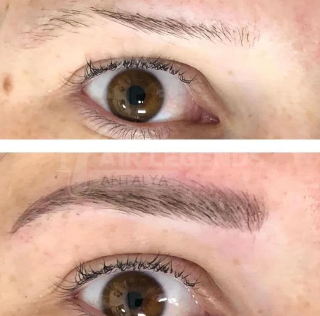 Hair Legends | Hair Transplant Antalya