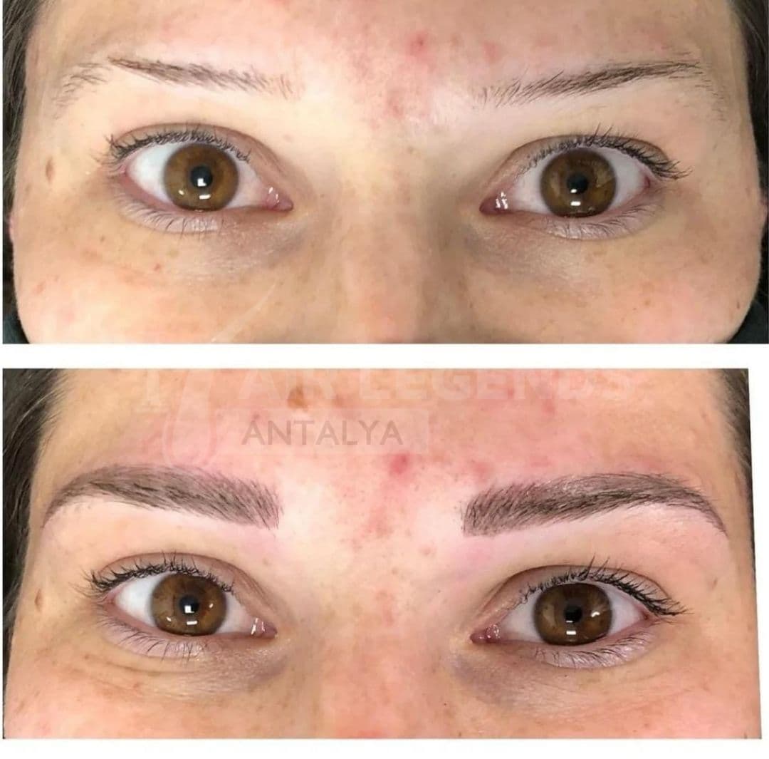 Hair Legends | Hair Transplant Antalya