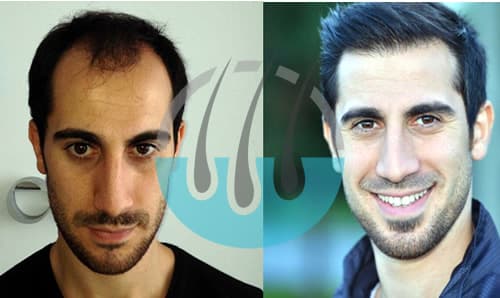 Hair Transplant Clinic Turkey