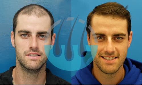 Hair Transplant Clinic Turkey