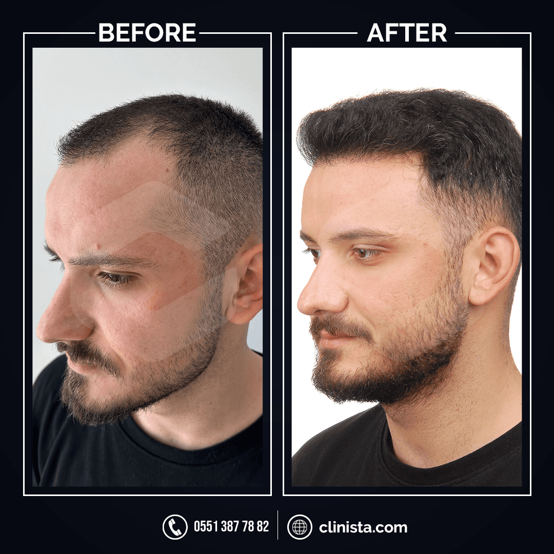 Clinista Hair Transplant