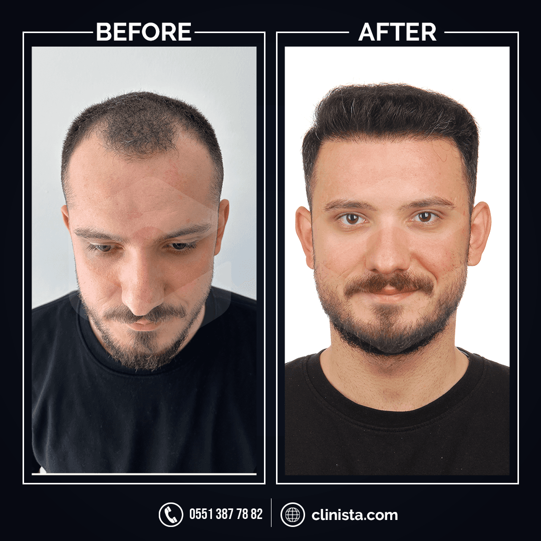 Clinista Hair Transplant
