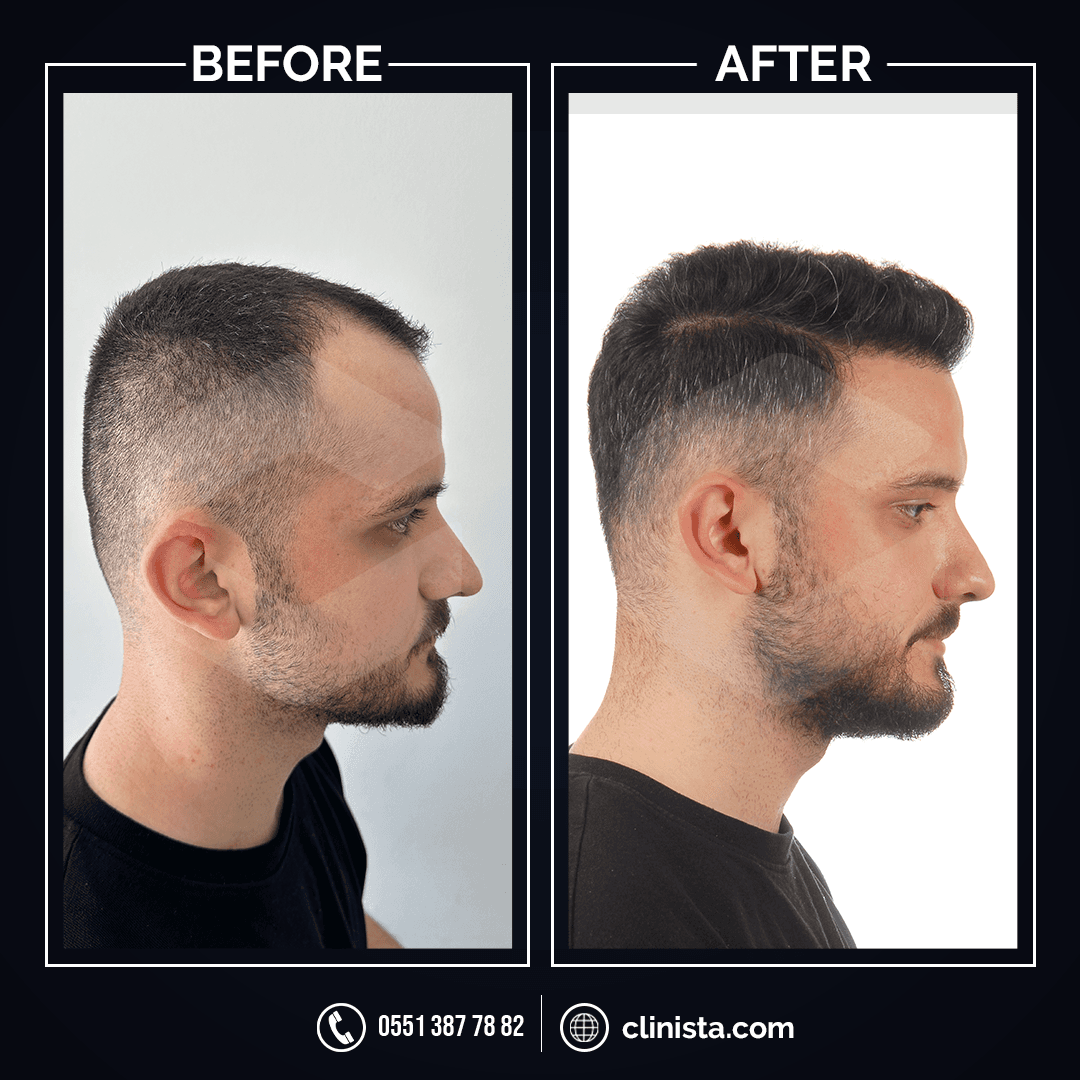 Clinista Hair Transplant