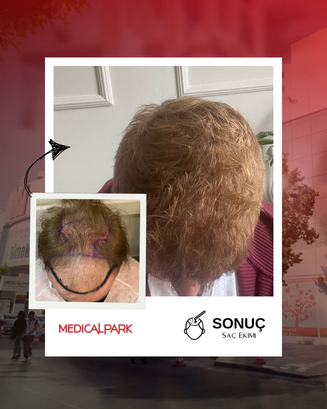 Medical Park Hastanesi Saç Ekim