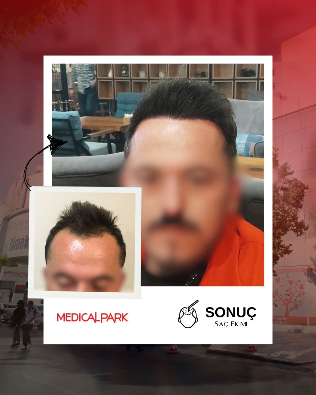 Medical Park Hastanesi Saç Ekim