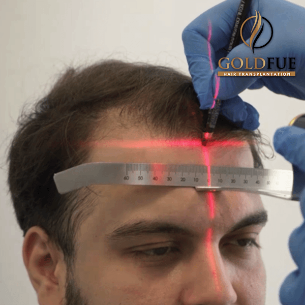 Gold Fue Hair Transplant