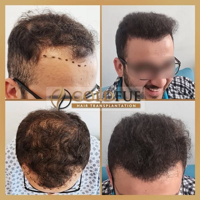 Gold Fue Hair Transplant