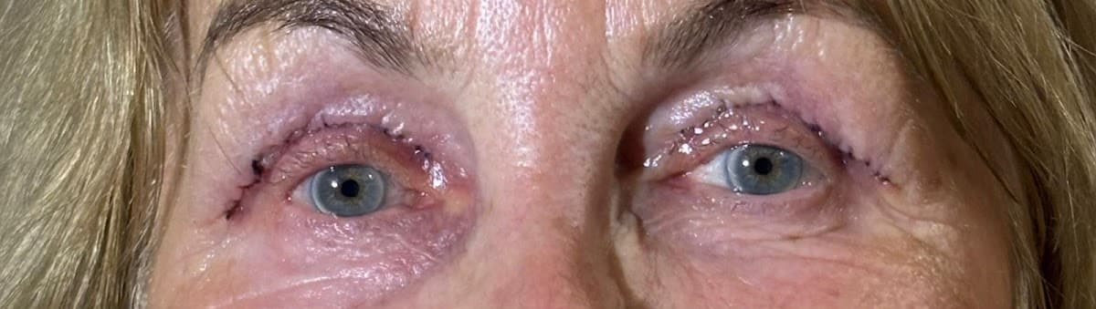 Dr. Emir Doğan / Laser Eye Surgery & Eyelid Aesthetic