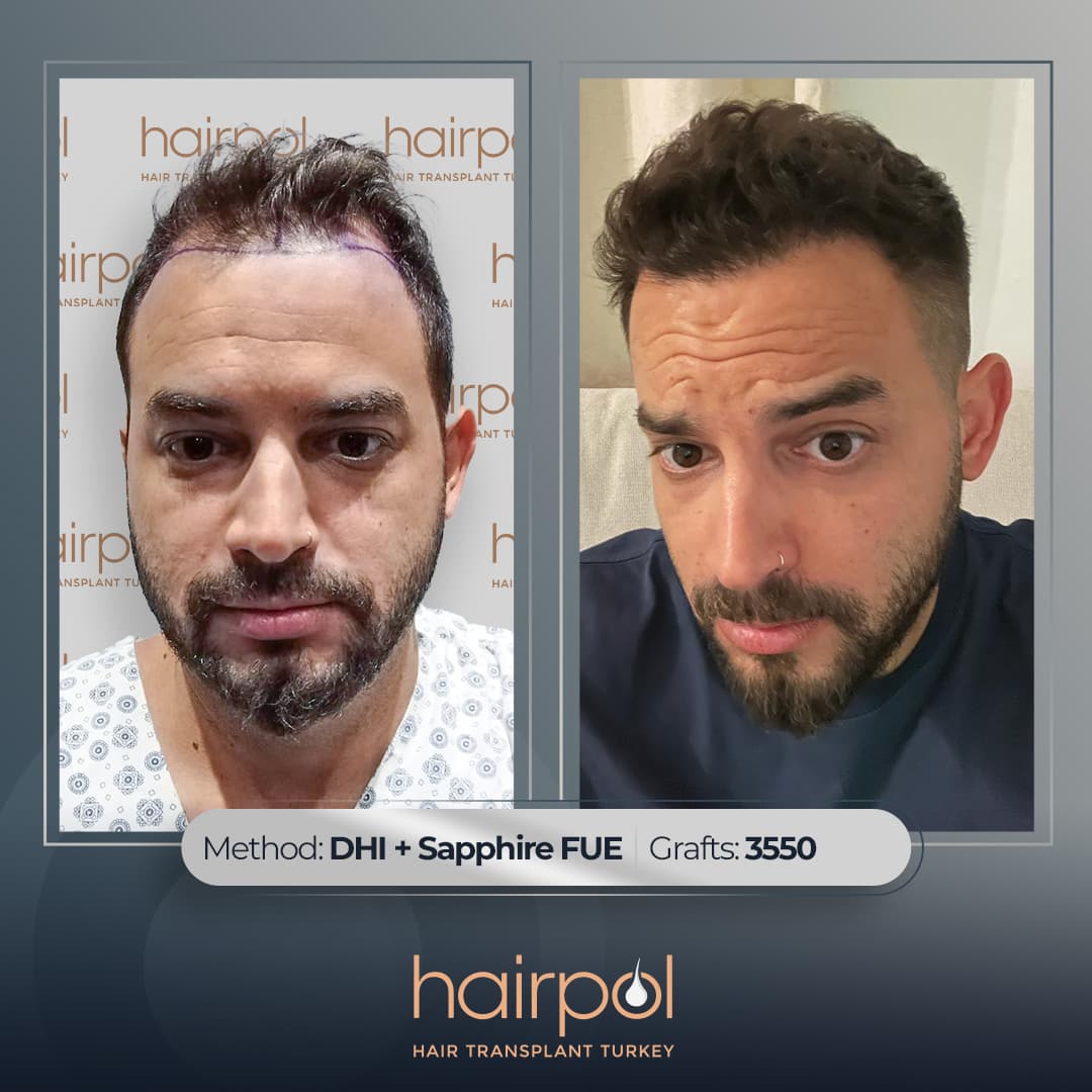 Hairpol | Hair Transplant Clinic (Saç Ekimi Kliniği)