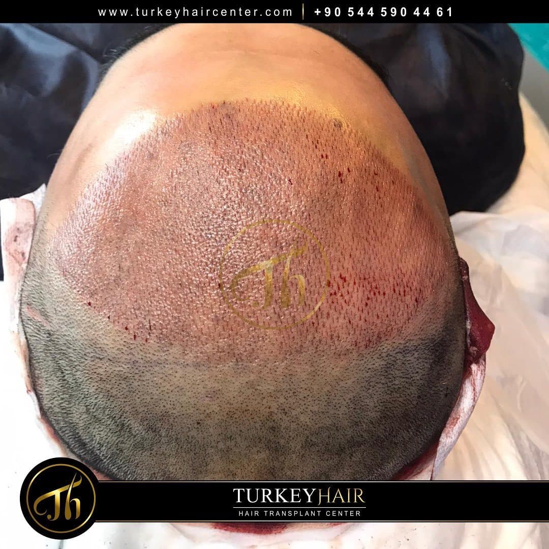 Turkey Hair Transplant Center