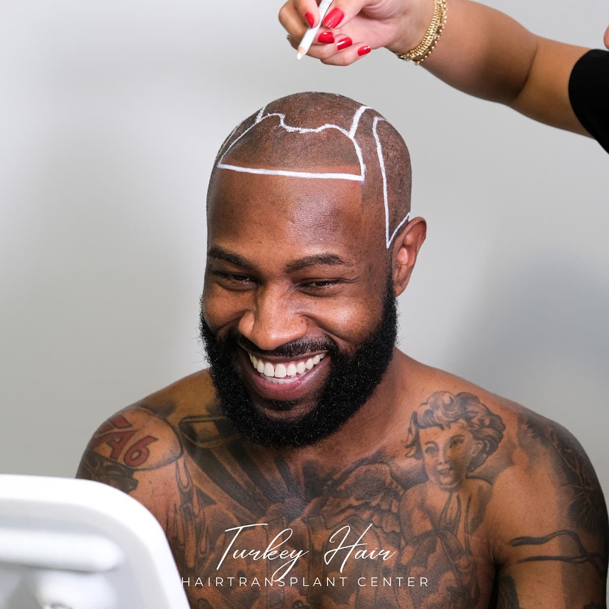 Turkey Hair Transplant Center