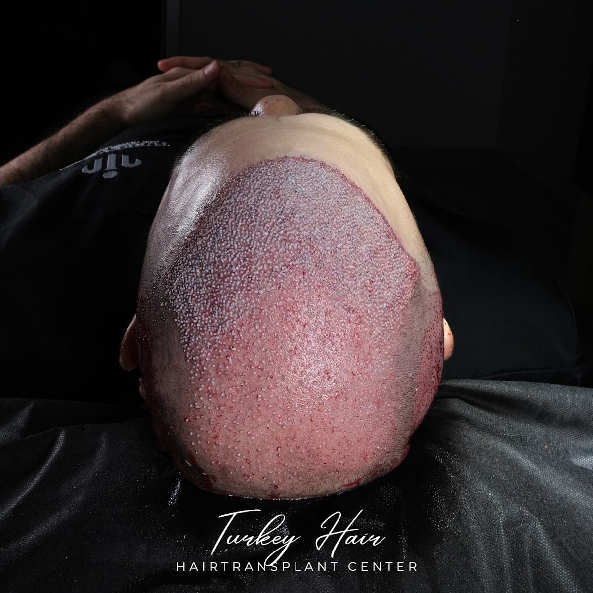 Turkey Hair Transplant Center