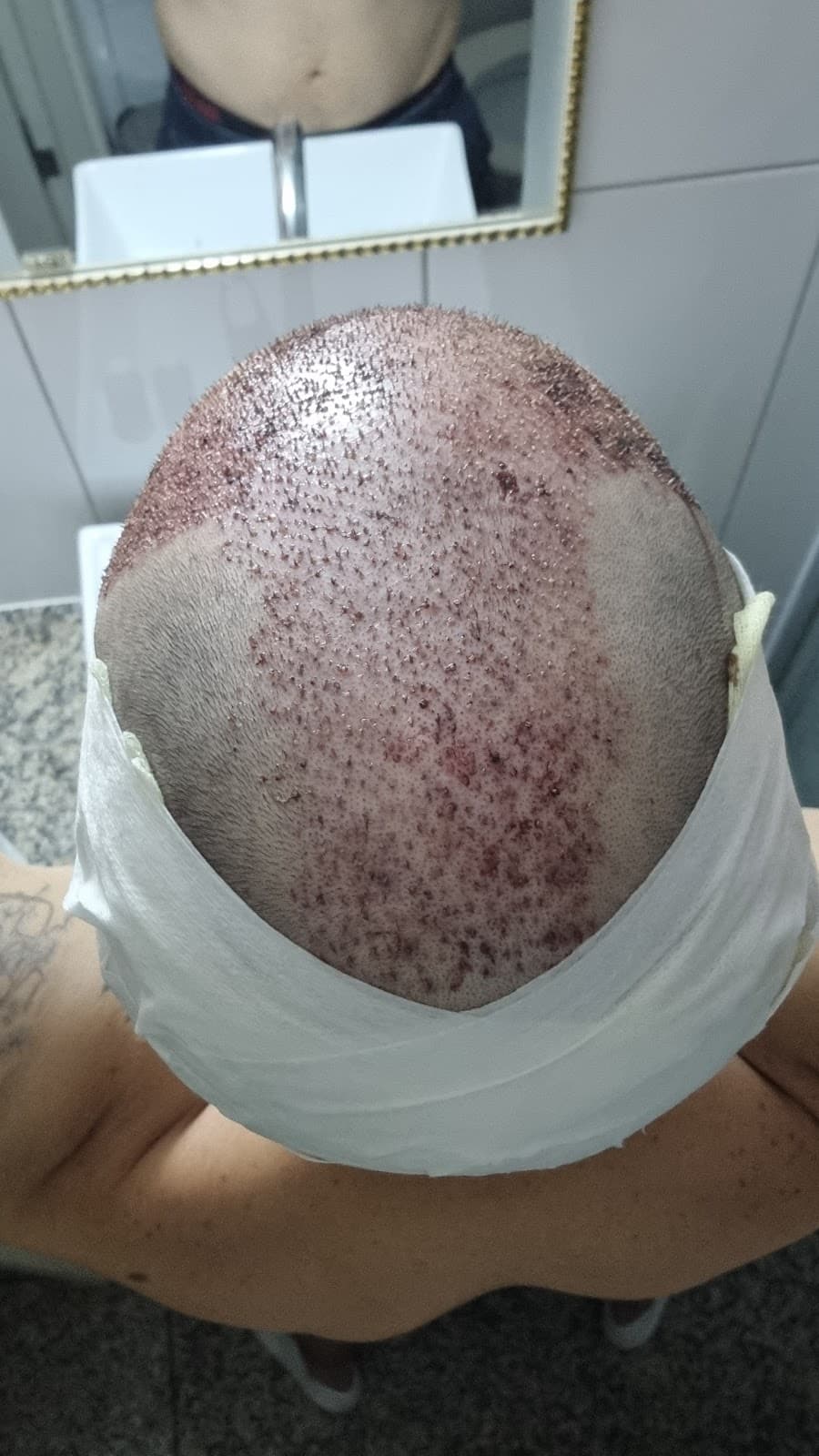 BT Hair Clinic Antalya