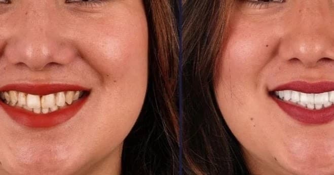 Ankara implant, Deha Dental, Ankara,Dikmen,Çankaya Da diş...