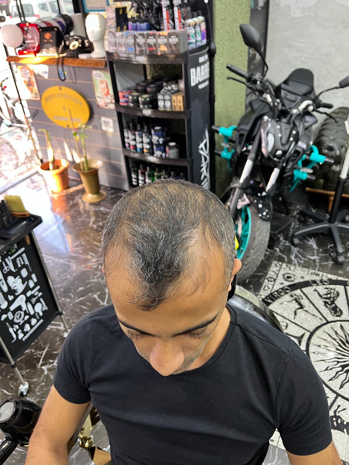 Hair of Istanbul | Hair Transplant Clinic