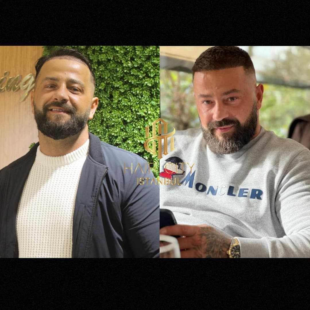 Hair City İstanbul Saç Ekimi