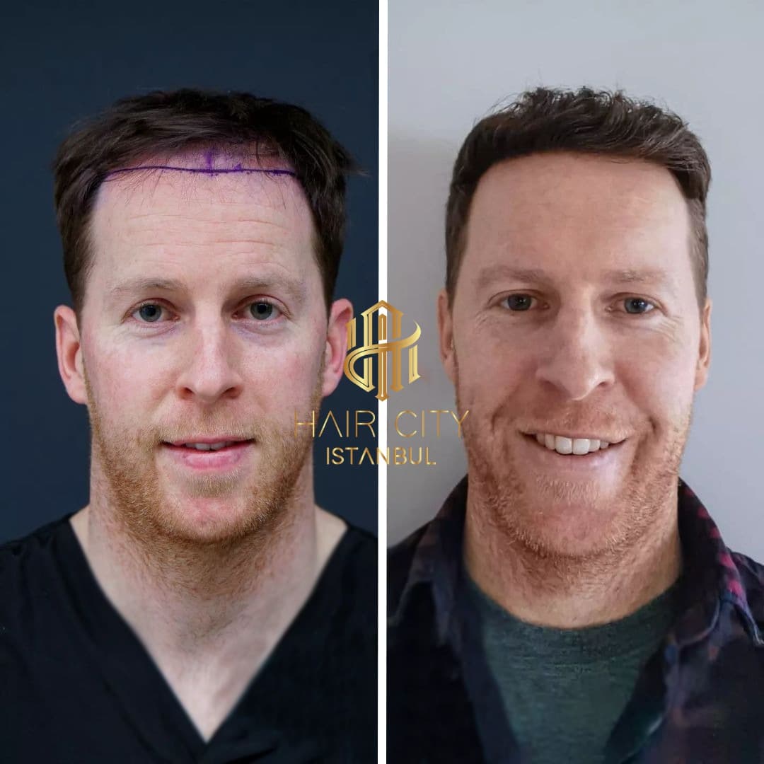 Hair City İstanbul Saç Ekimi