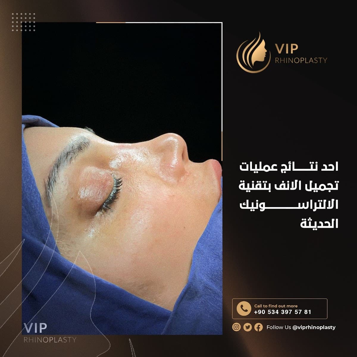 Vip rhinoplasty