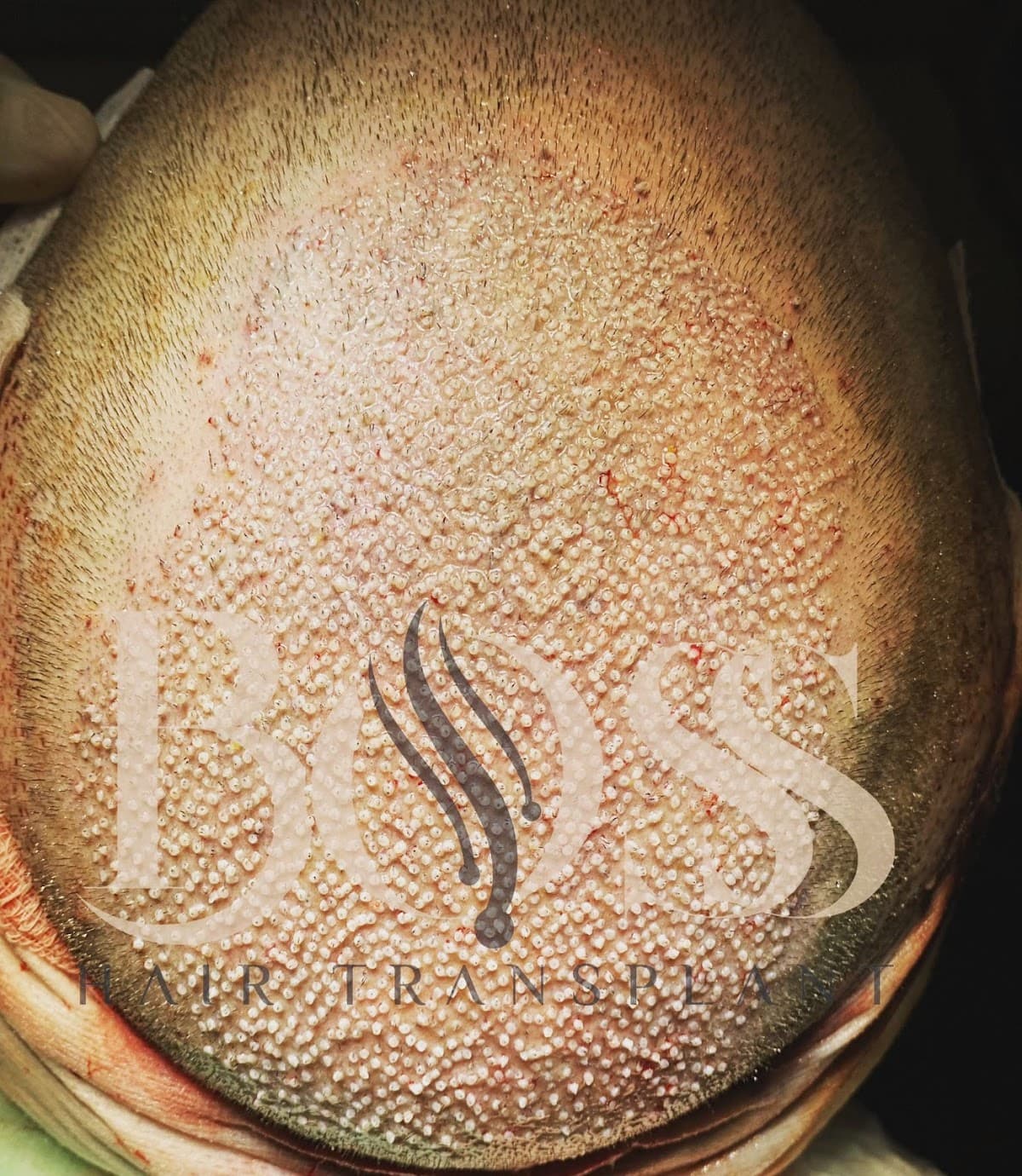 Boss Hair Transplant