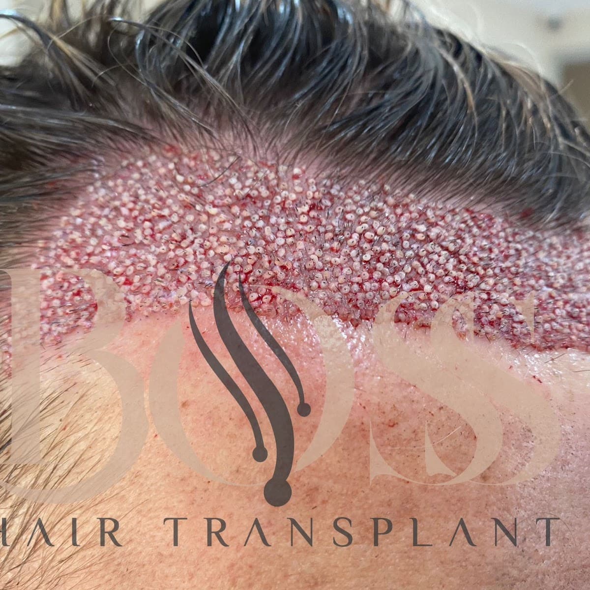 Boss Hair Transplant