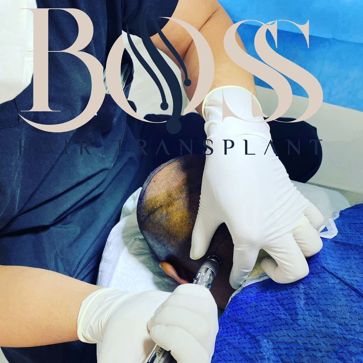 Boss Hair Transplant