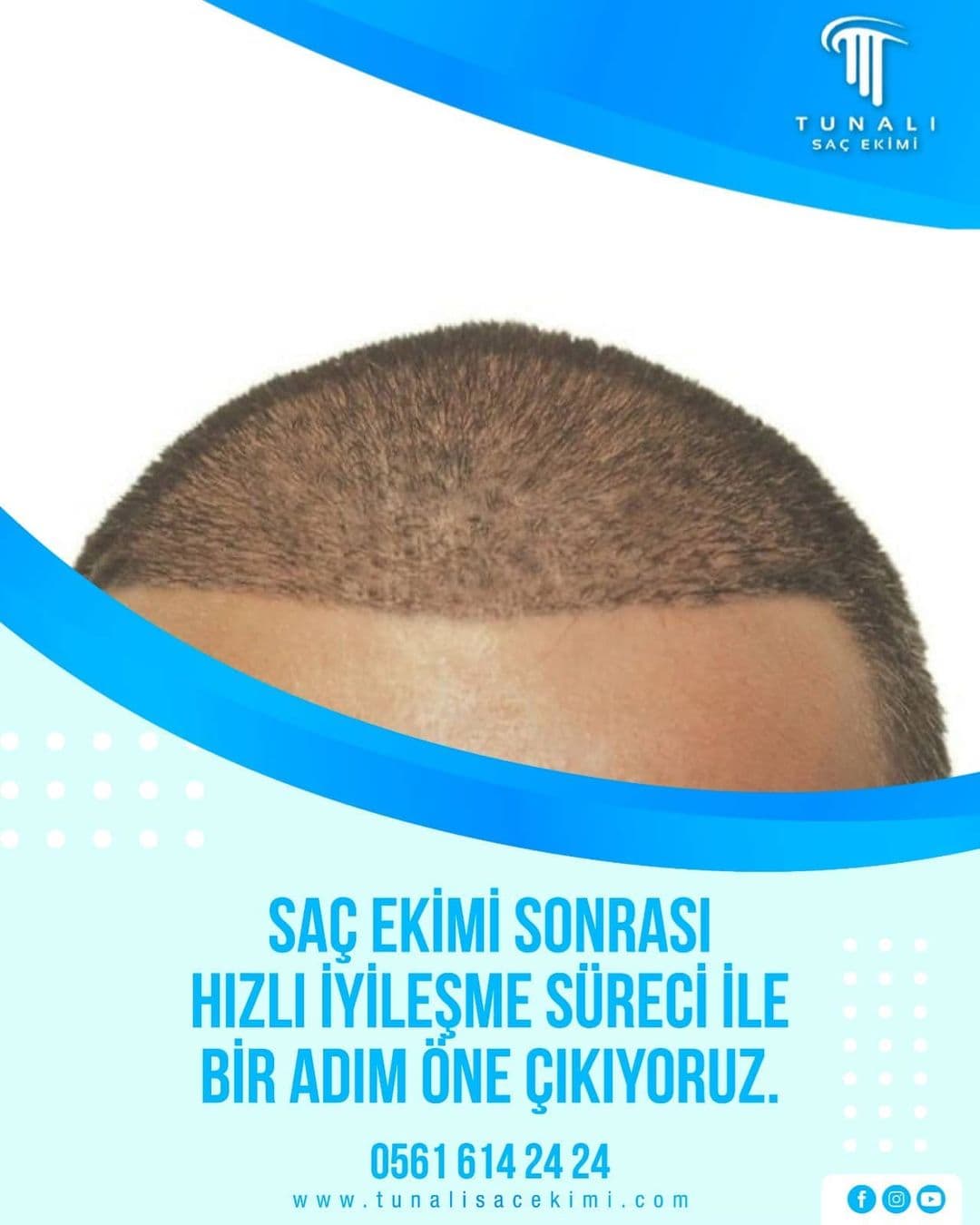 Tunalı Saç Ekimi I Ankara Saç ekimi