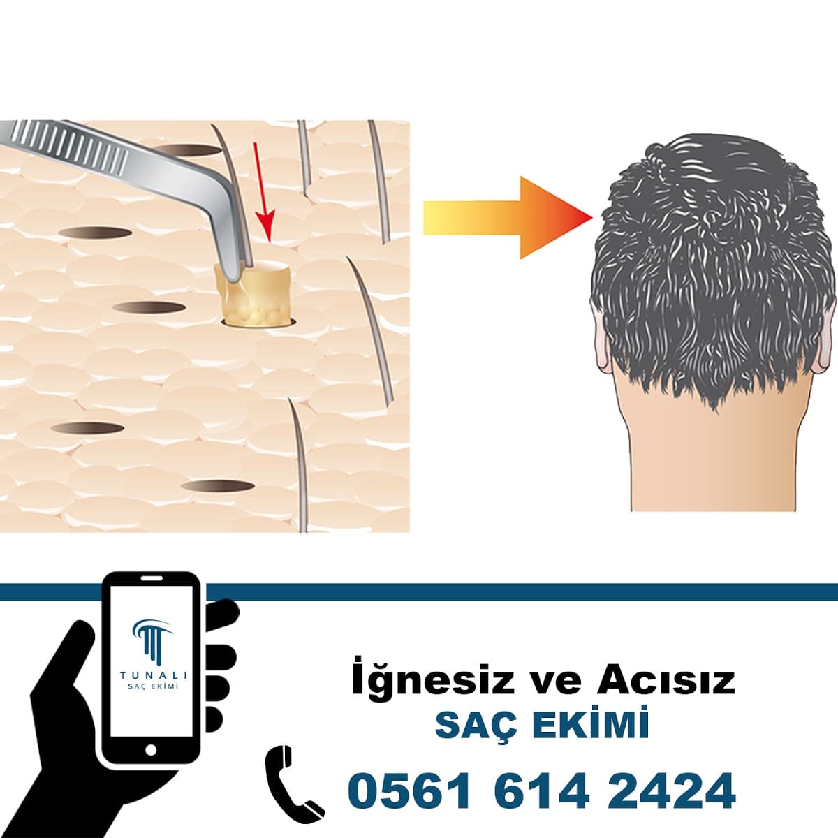 Tunalı Saç Ekimi I Ankara Saç ekimi