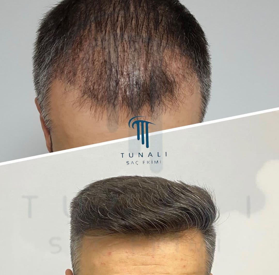 Tunalı Saç Ekimi I Ankara Saç ekimi