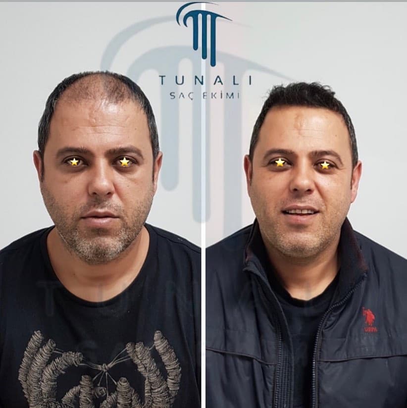 Tunalı Saç Ekimi I Ankara Saç ekimi