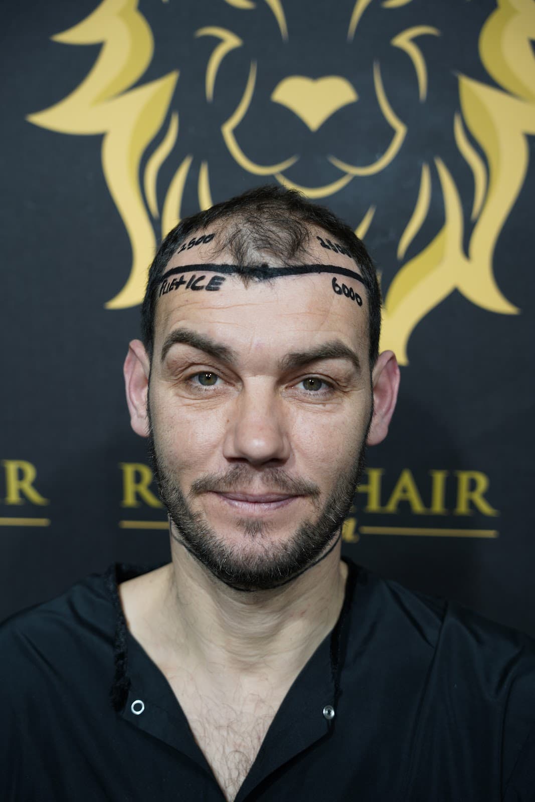 Royal Hair Istanbul | Hair Transplant Turkey