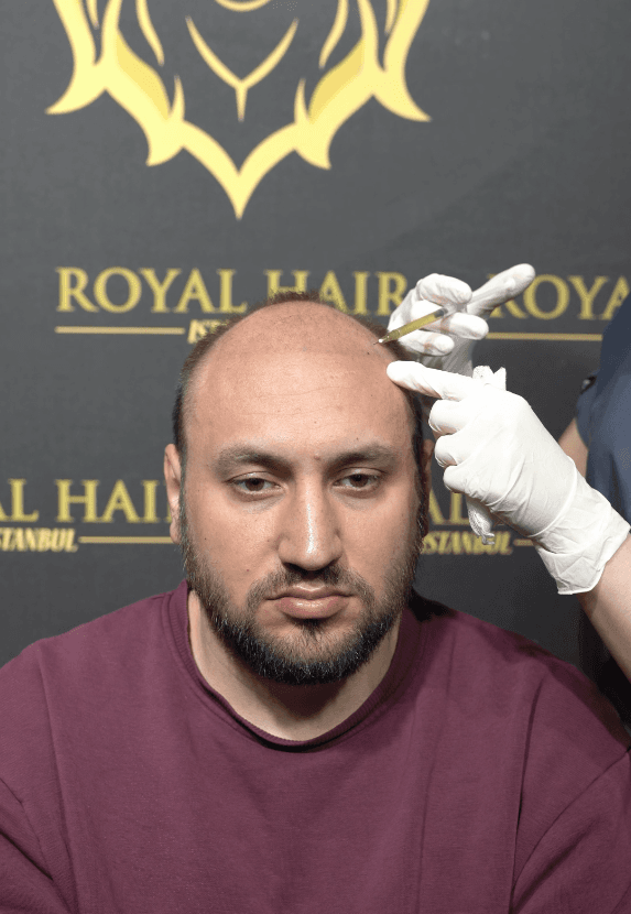 Royal Hair Istanbul | Hair Transplant Turkey