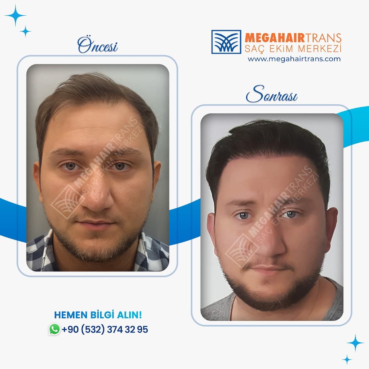 Mega Hair Trans Hair Transplant Center Etiler