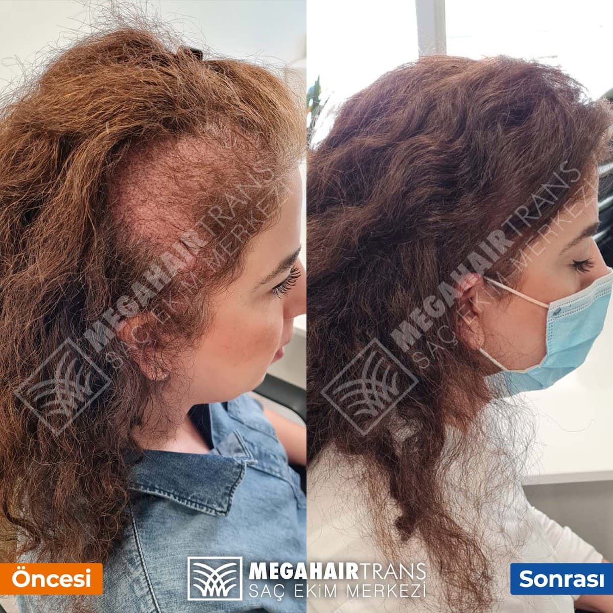 Mega Hair Trans Hair Transplant Center Etiler