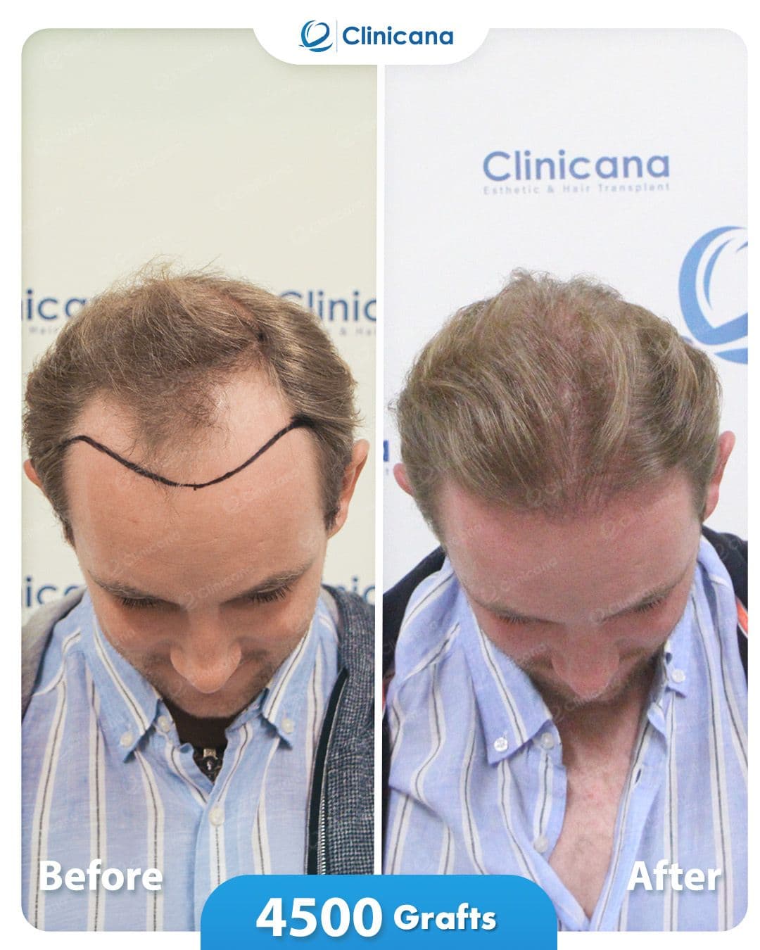 Clinicana Hair Transplant & Esthetic Surgeries
