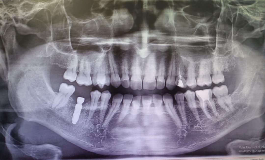 DR MERT AKBAŞ DİŞ KLİNİĞİ-1 ÇENE CERRAHİSİ ZİGOMATİK İMPLANT - MAXILLOFACIAL SURGERY - Dentist - Zahnarzt- стоматолог