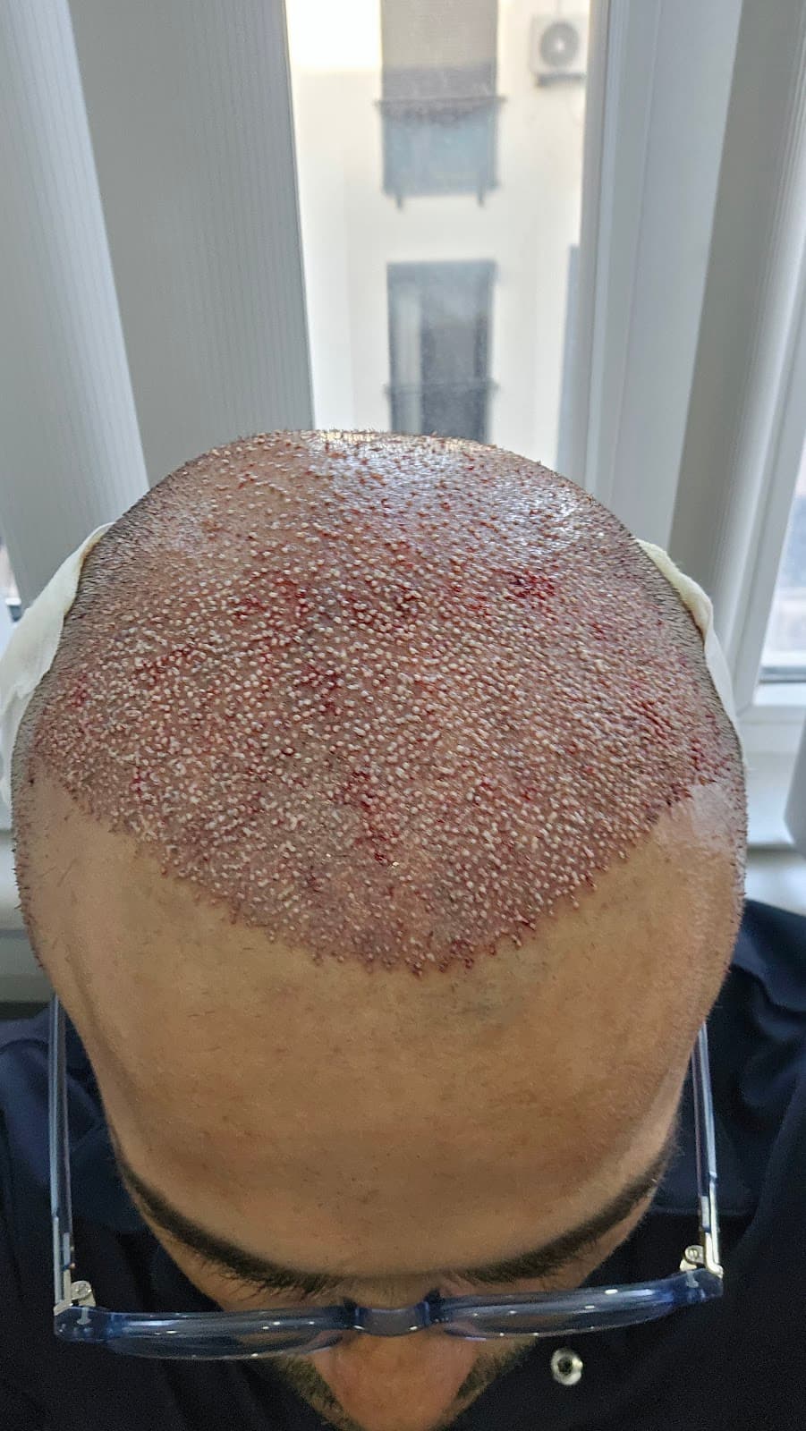 byhairclinic | Hair Transplant Center