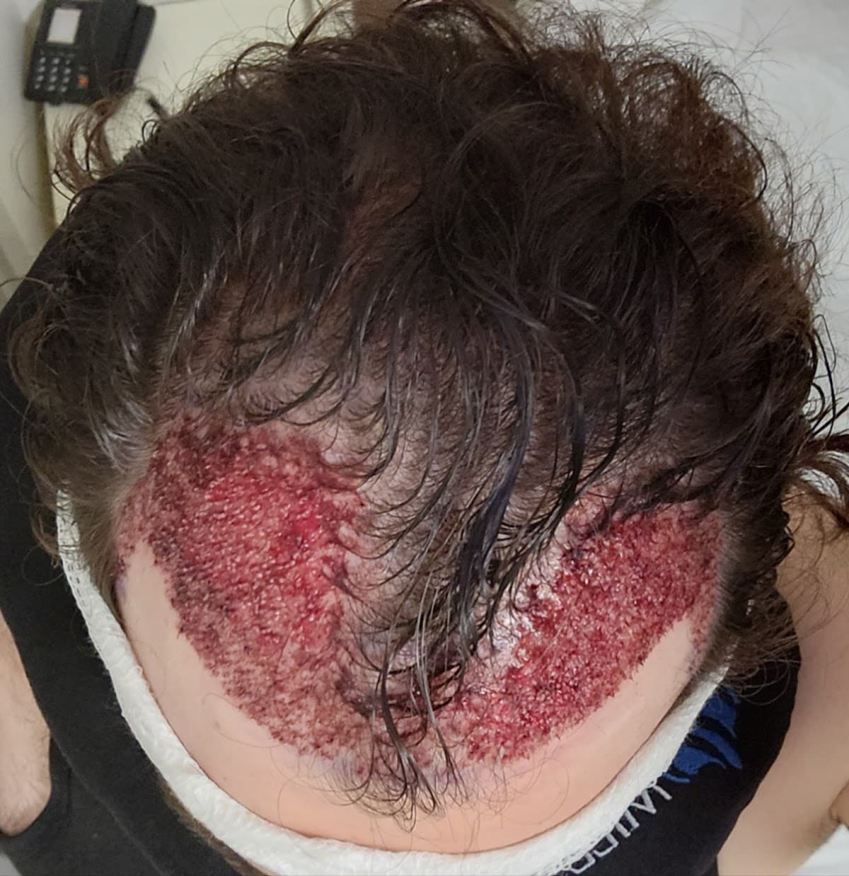 Este in Turkey | Hair Transplant - Plastic Surgery