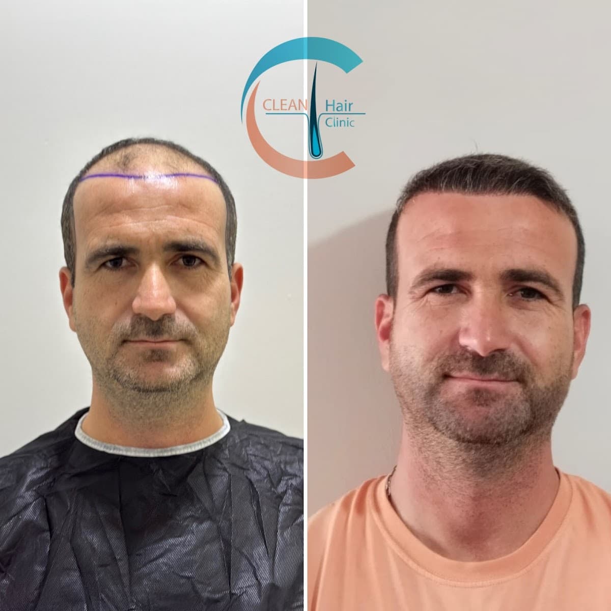 Clean Saç Ekim Merkezi