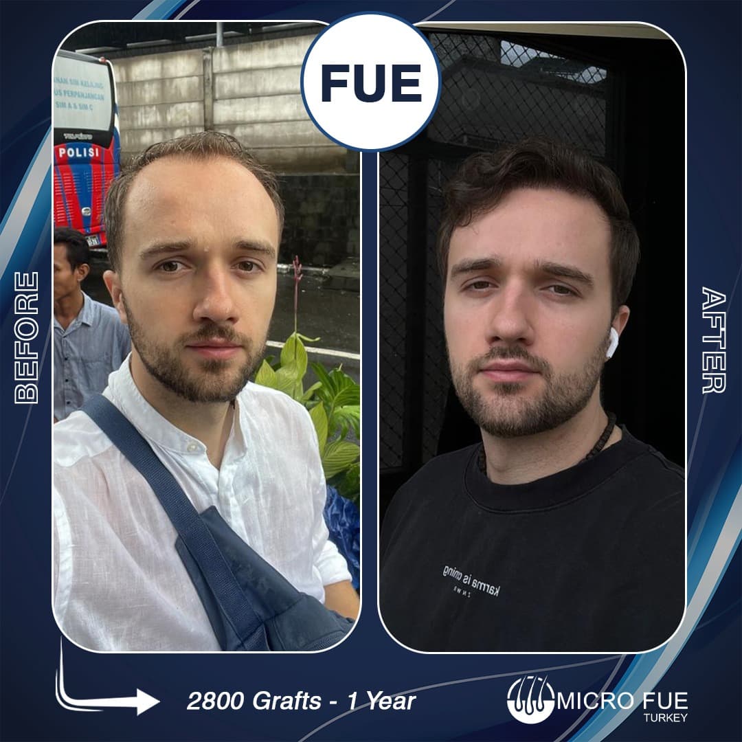 Beard Transplant Turkey