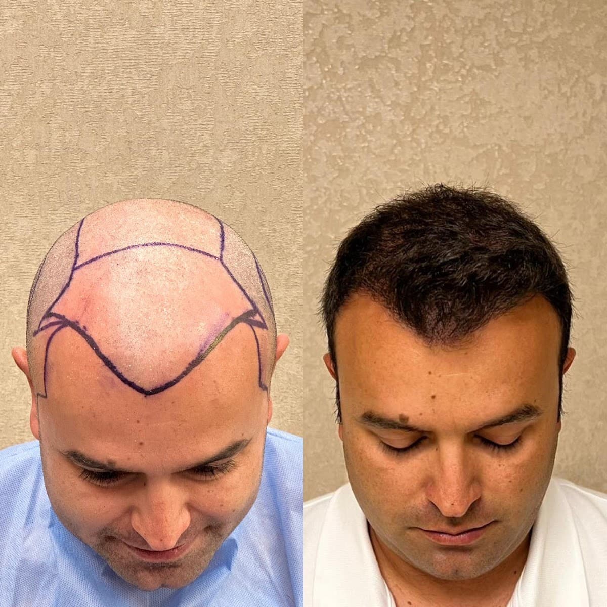 Görkem Kazan Saç Ekimi