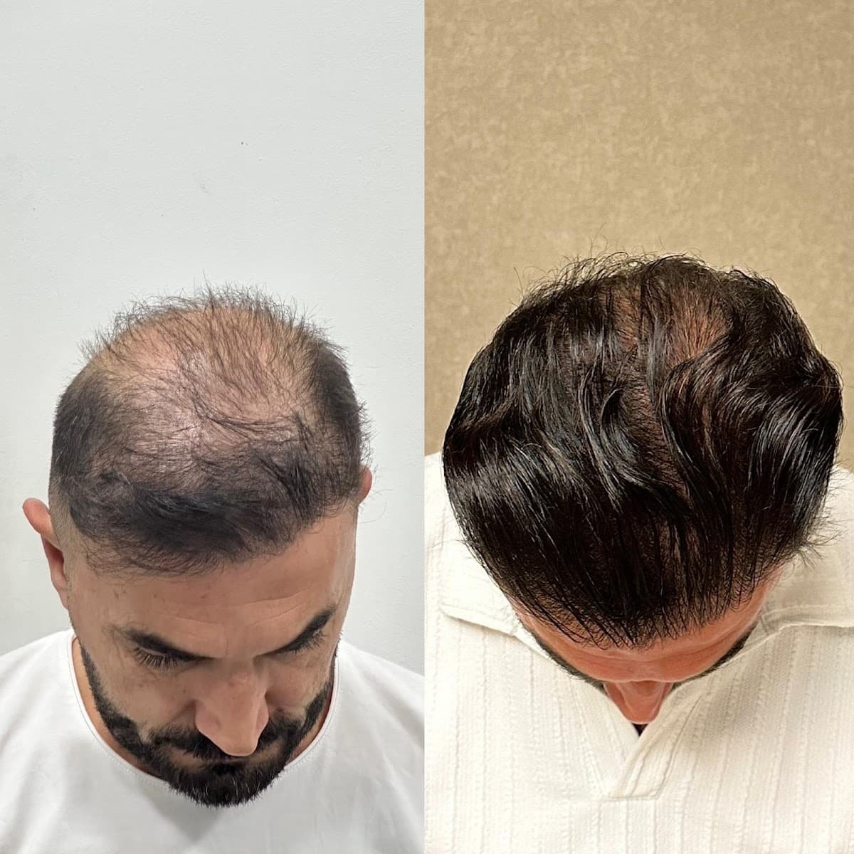 Görkem Kazan Saç Ekimi