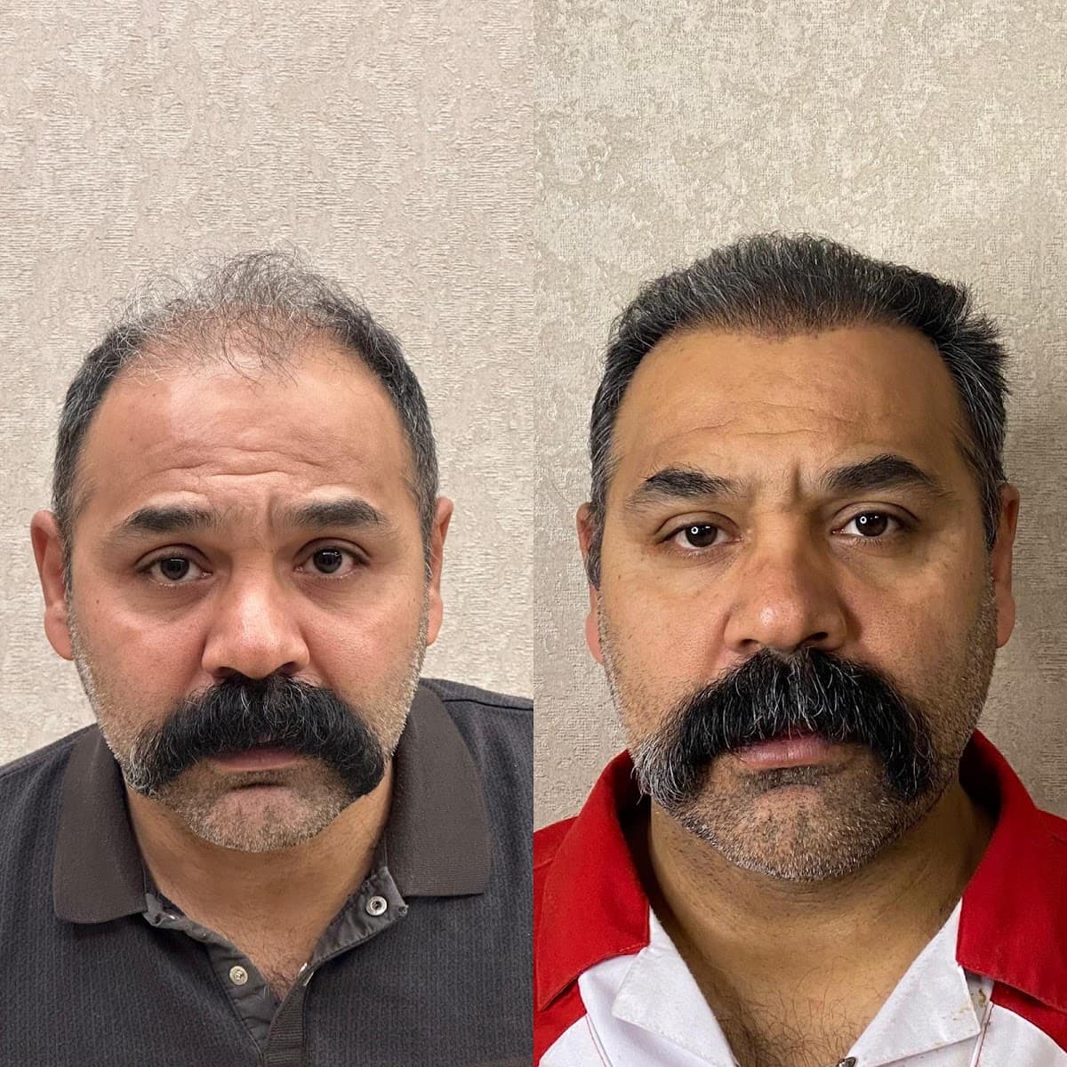 Görkem Kazan Saç Ekimi