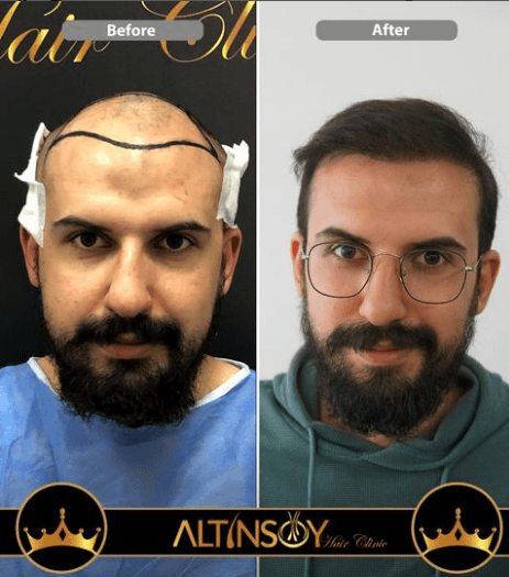 Hair Transplant Of Antalya / Antalya Saç Ekimi / Altınsoy...