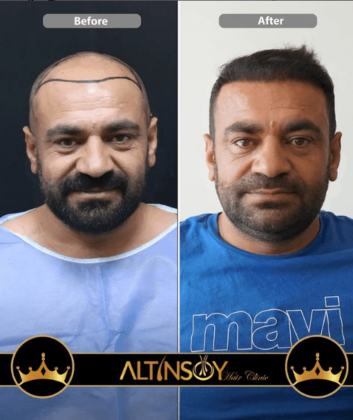 Hair Transplant Of Antalya / Antalya Saç Ekimi / Altınsoy...