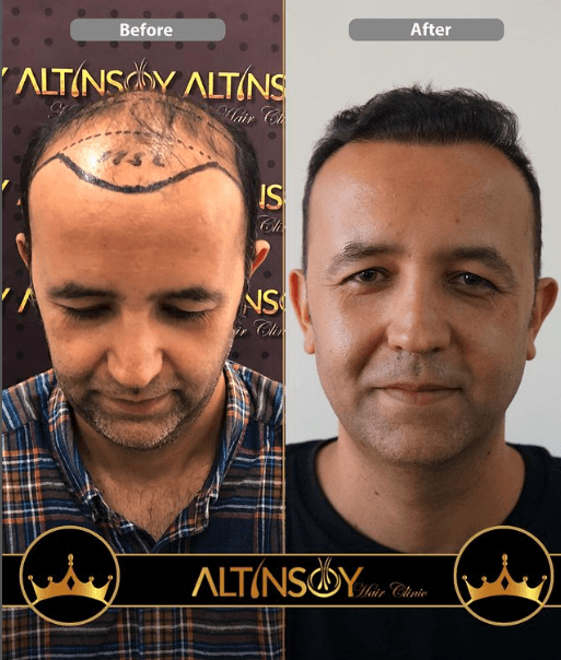 Hair Transplant Of Antalya / Antalya Saç Ekimi / Altınsoy...