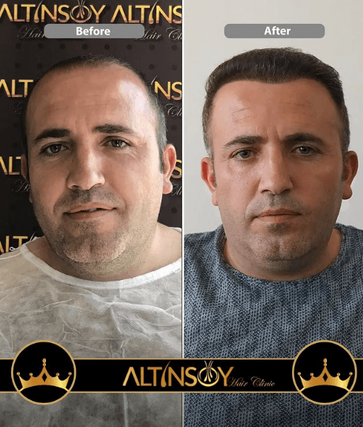 Hair Transplant Of Antalya / Antalya Saç Ekimi / Altınsoy...